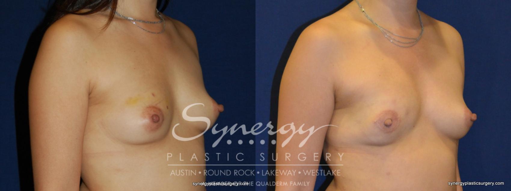 Before & After  Case 236 View #1 View in Austin, TX