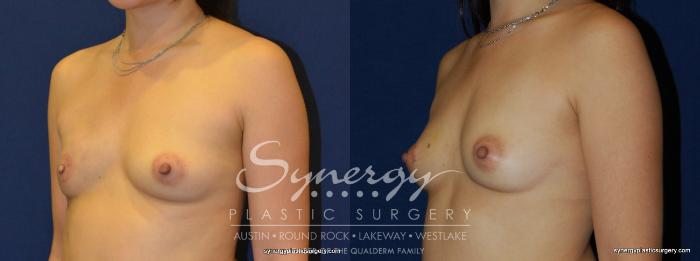 Before & After  Case 236 View #4 View in Austin, TX