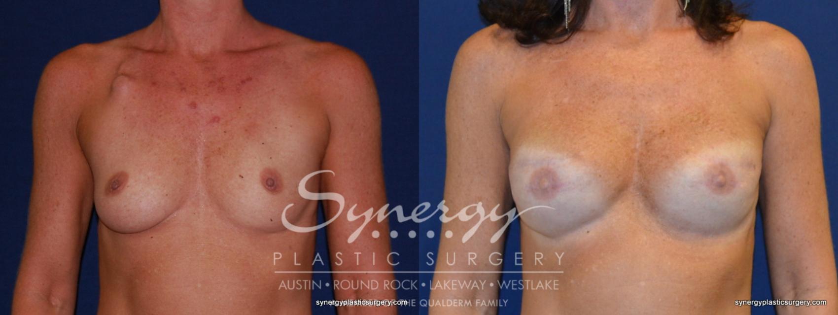 Before & After Reconstruction - Breast Cancer Case 237 View #1 View in Austin, TX