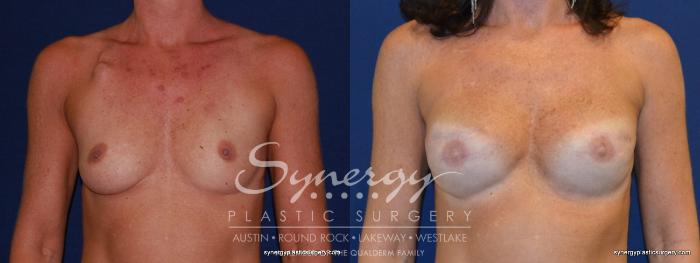 Before & After Reconstruction - Breast Cancer Case 237 View #1 View in Austin, TX