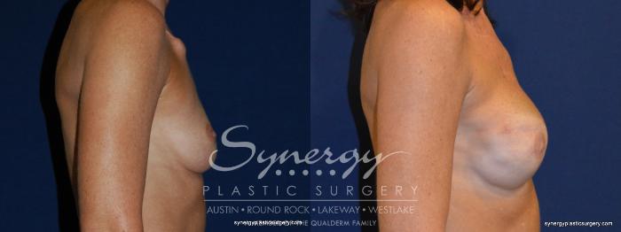 Before & After Reconstruction - Breast Cancer Case 237 View #3 View in Austin, TX