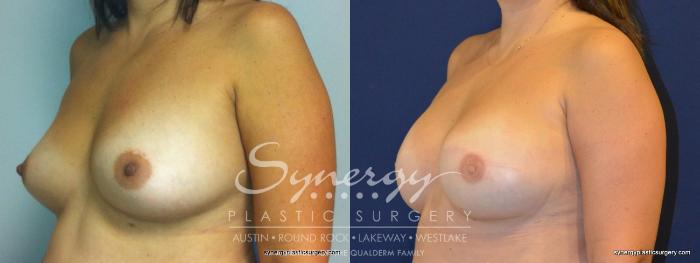 Before & After  Case 238 View #4 View in Austin, TX