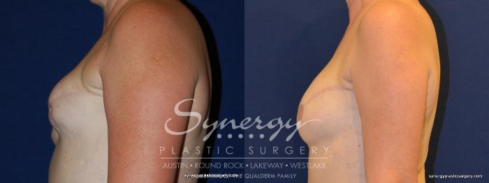 Before & After  Case 239 View #3 View in Austin, TX