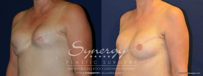 Before & After  Case 239 View #4 View in Austin, TX