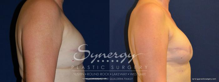 Before & After  Case 239 View #5 View in Austin, TX