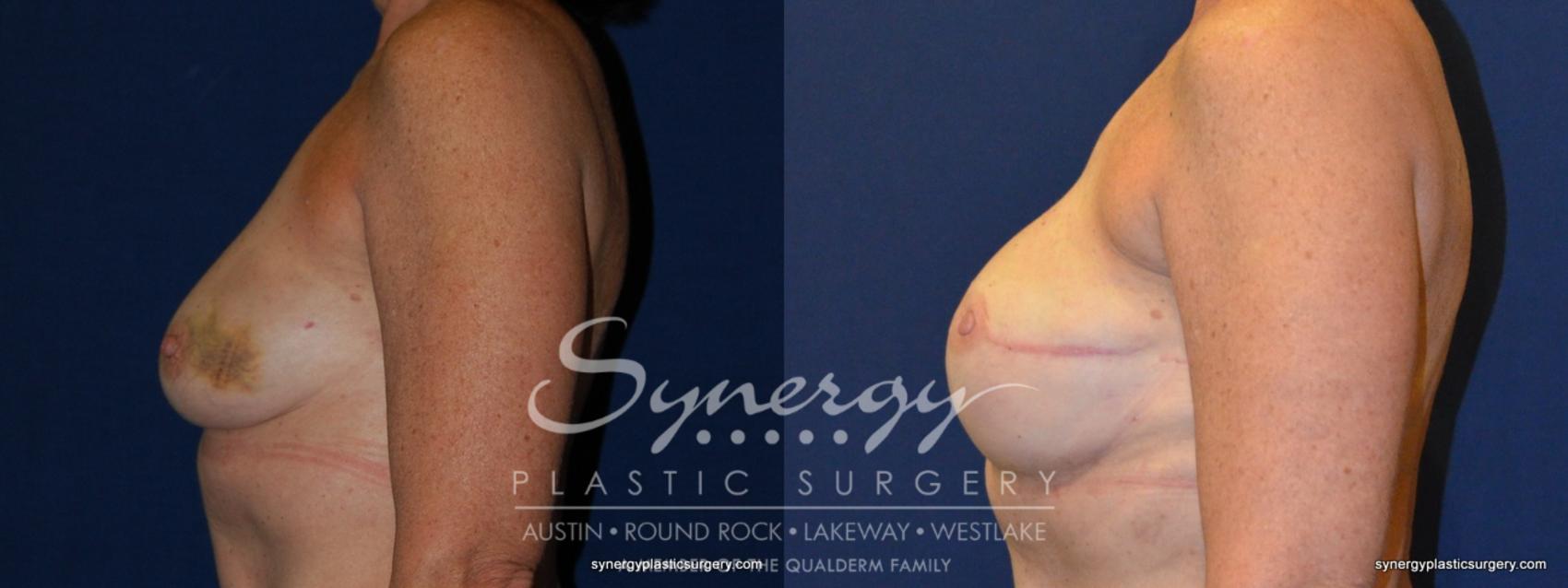 Before & After Reconstruction - Breast Cancer Case 240 View #1 View in Austin, TX