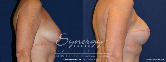 Before & After Reconstruction - Breast Cancer Case 240 View #3 View in Austin, TX