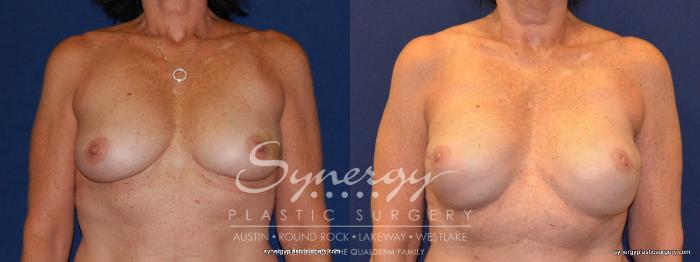 Before & After Reconstruction - Breast Cancer Case 240 View #5 View in Austin, TX