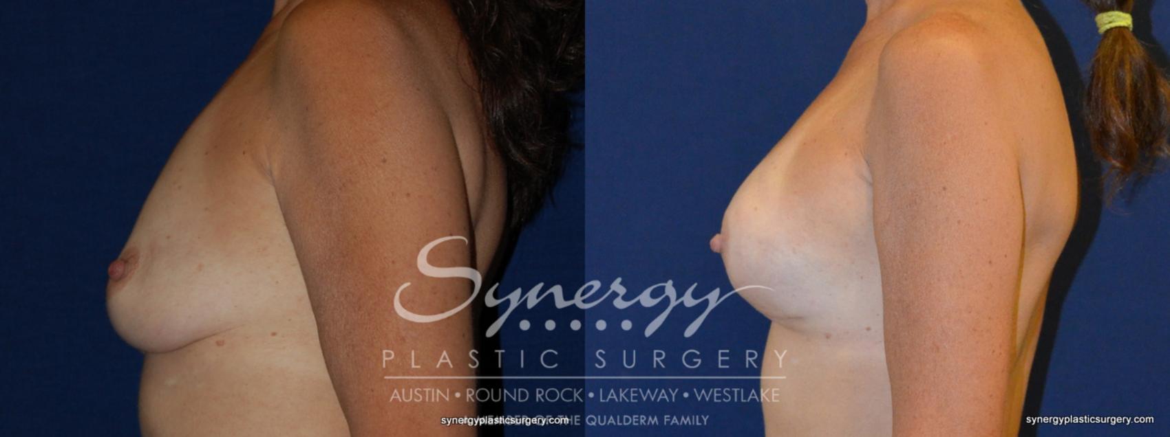 Before & After Reconstruction - Breast Cancer Case 241 View #1 View in Austin, TX