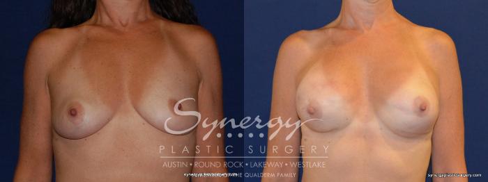 Before & After Reconstruction - Breast Cancer Case 241 View #2 View in Austin, TX
