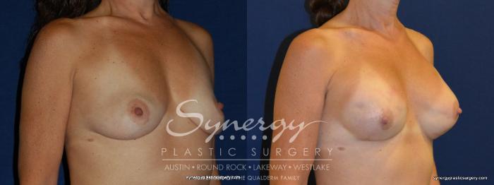 Before & After Reconstruction - Breast Cancer Case 241 View #3 View in Austin, TX