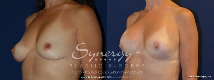 Before & After Reconstruction - Breast Cancer Case 241 View #4 View in Austin, TX