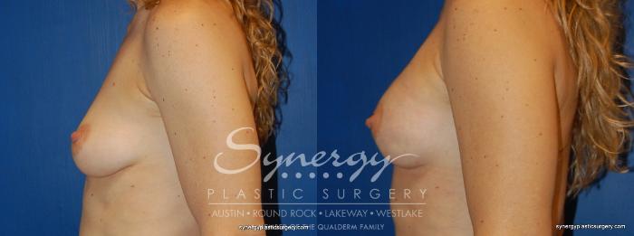 Before & After  Case 243 View #2 View in Austin, TX