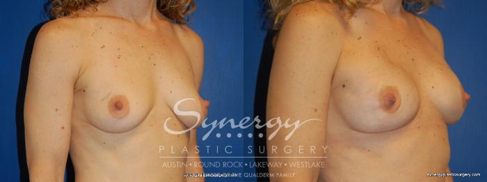 Before & After  Case 243 View #3 View in Austin, TX