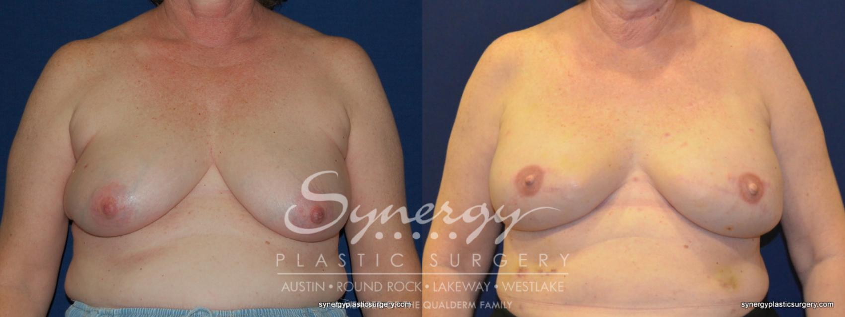 Before & After  Case 247 View #1 View in Austin, TX