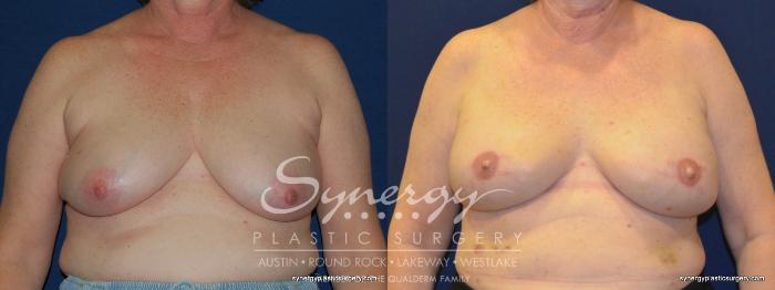 Before & After Reconstruction - Breast Cancer Case 247 View #1 View in Austin, TX