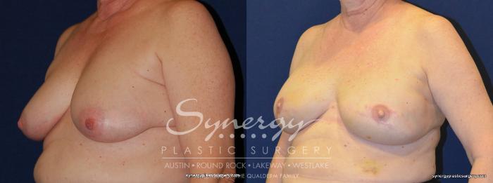 Before & After  Case 247 View #2 View in Austin, TX