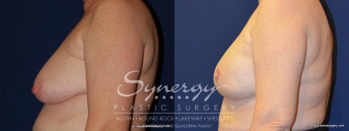 Before & After  Case 247 View #3 View in Austin, TX