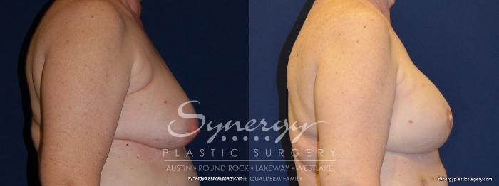 Before & After  Case 247 View #5 View in Austin, TX