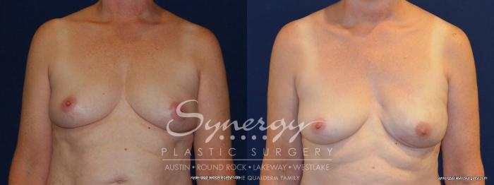 Before & After Reconstruction - Breast Cancer Case 254 View #1 View in Austin, TX