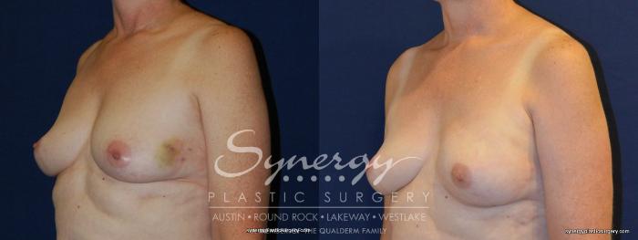 Before & After Reconstruction - Breast Cancer Case 254 View #3 View in Austin, TX