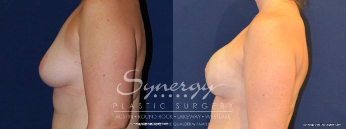 Before & After Reconstruction - Breast Cancer Case 342 View #2 View in Austin, TX