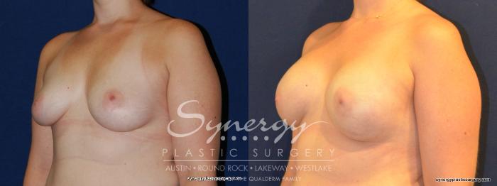 Before & After Reconstruction - Breast Cancer Case 342 View #3 View in Austin, TX