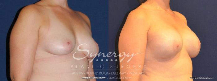 Before & After Reconstruction - Breast Cancer Case 342 View #5 View in Austin, TX