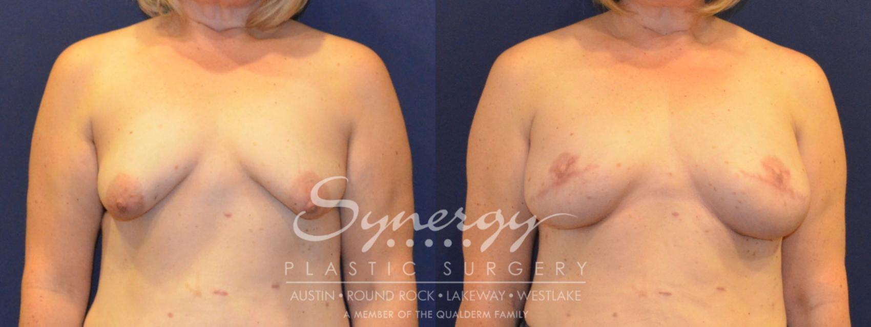 Before & After Reconstruction - Breast Cancer Case 365 View #1 View in Austin, TX