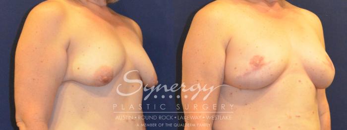 Before & After Reconstruction - Breast Cancer Case 365 View #2 View in Austin, TX