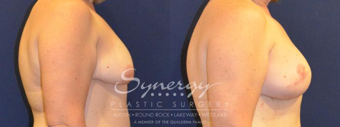 Before & After Reconstruction - Breast Cancer Case 365 View #3 View in Austin, TX