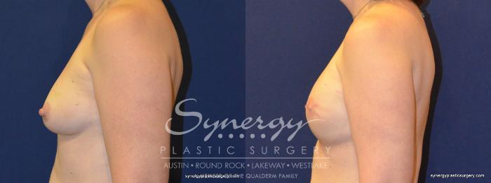 Before & After Reconstruction - Breast Cancer Case 368 View #2 View in Austin, TX