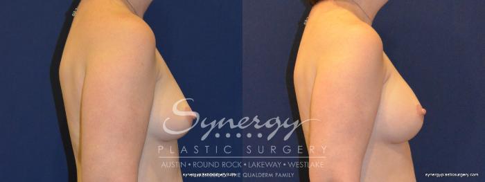 Before & After Reconstruction - Breast Cancer Case 368 View #4 View in Austin, TX