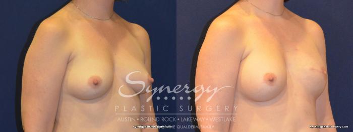 Before & After Reconstruction - Breast Cancer Case 368 View #5 View in Austin, TX