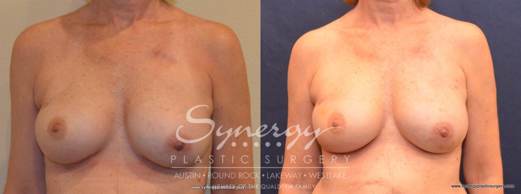 Before & After Reconstruction - Breast Cancer Case 404 View #1 View in Austin, TX