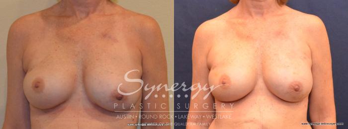 Before & After Reconstruction - Breast Cancer Case 404 View #1 View in Austin, TX
