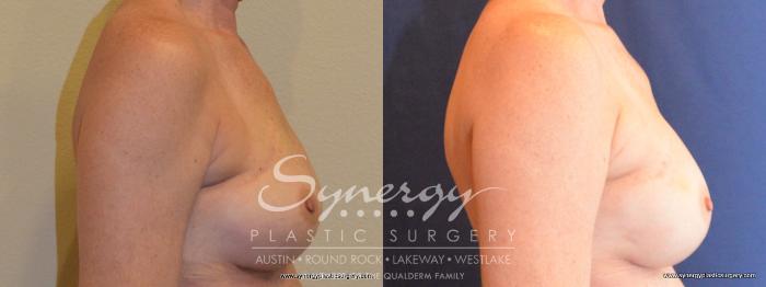 Before & After Reconstruction - Breast Cancer Case 404 View #4 View in Austin, TX