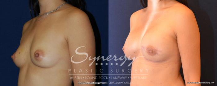 Before & After Reconstruction - Breast Cancer Case 540 View #2 View in Austin, TX