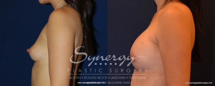 Before & After Reconstruction - Breast Cancer Case 540 View #3 View in Austin, TX