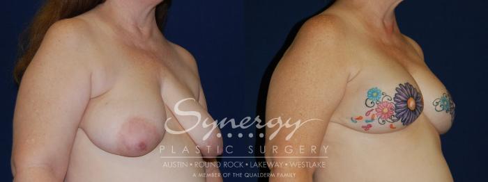 Before & After  Case 97 View #2 View in Austin, TX