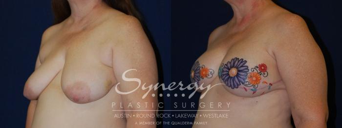 Before & After  Case 97 View #3 View in Austin, TX