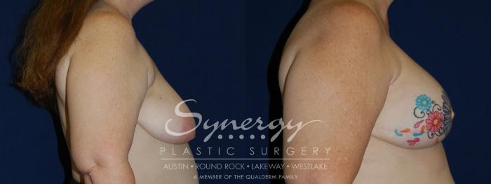 Before & After  Case 97 View #4 View in Austin, TX