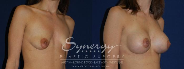 Before & After  Case 134 View #3 View in Austin, TX