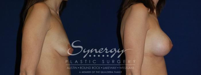 Before & After  Case 134 View #5 View in Austin, TX