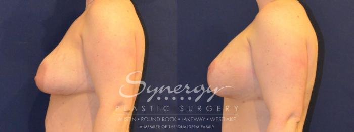 Before & After  Case 394 View #4 View in Austin, TX