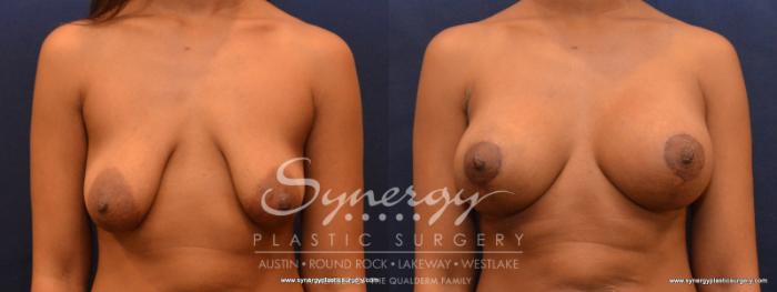 Before & After Reconstruction - Congenital Breast Case 568 View #1 View in Austin, TX