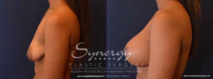 Before & After  Case 568 View #3 View in Austin, TX