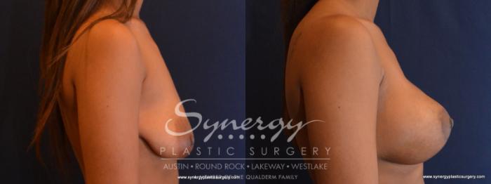 Before & After  Case 568 View #5 View in Austin, TX