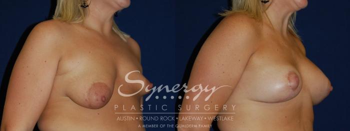 Before & After  Case 91 View #1 View in Austin, TX