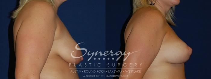 Before & After  Case 91 View #4 View in Austin, TX